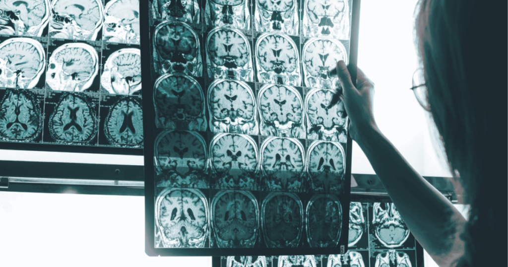 Un índice cerebral mejora la medición del Alzheimer y alerta de cambios previos a los síntomas