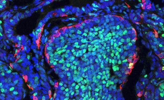 Alerta de la OMS expone el costo de la desigualdad: el cáncer mata 26 mil personas al día; mientras persisten brechas de acceso